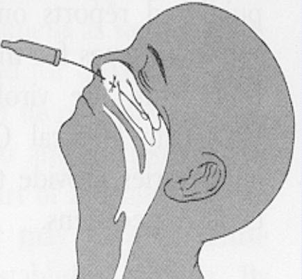 NP_Swab_Diagram1 NP_Swab_Diagram1